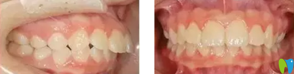 太原眾牙口腔做金屬托槽矯正牙齒前