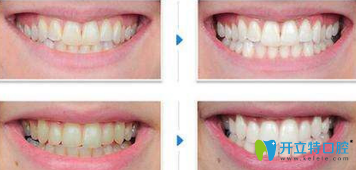 西妃口腔牙齒冷光美白案例效果展示