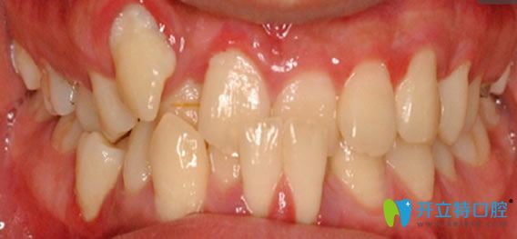 成都瑞安口腔劉思江醫(yī)生牙齒正畸前 成都瑞安口腔劉思江醫(yī)生牙齒正畸前