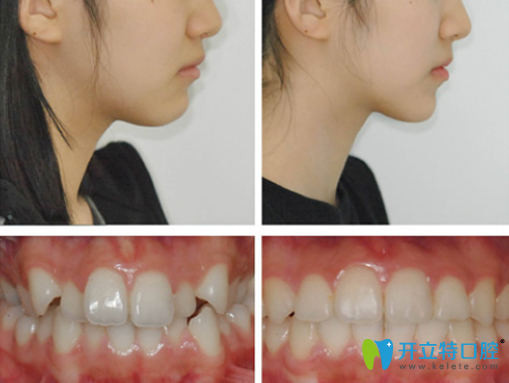 在東莞西妃口腔做牙齒矯正案例前后對比圖