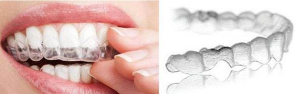 哪些人不適合戴隱形牙套 牙套的種類、價(jià)格及優(yōu)劣勢(shì)大比拼