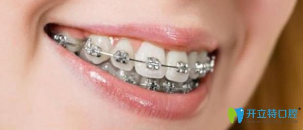 金屬托槽矯治器價格比較實惠