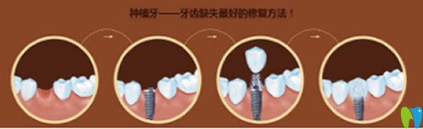 成都瑞安口腔種植牙過程
