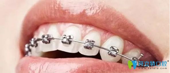 金屬自鎖托槽矯治器