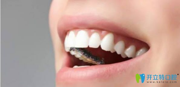 舌側(cè)矯治器正畸效果好