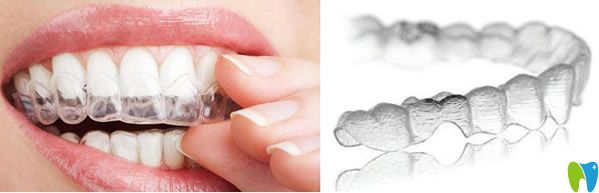 隱形矯治器美觀方便