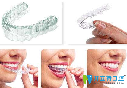 隱形牙套有哪些品牌？揭曉國產(chǎn)和進(jìn)口牙套種類及價格表