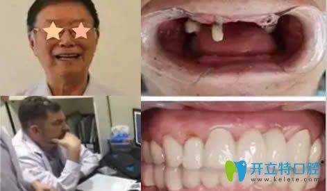 重慶皇仕口腔院長(zhǎng)舒斯特種植牙效果對(duì)比照
