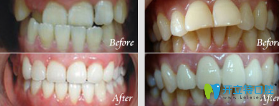 魯璇牙齒矯正真人案例前后效果對(duì)比圖 魯璇牙齒矯正真人案例前后效果對(duì)比圖