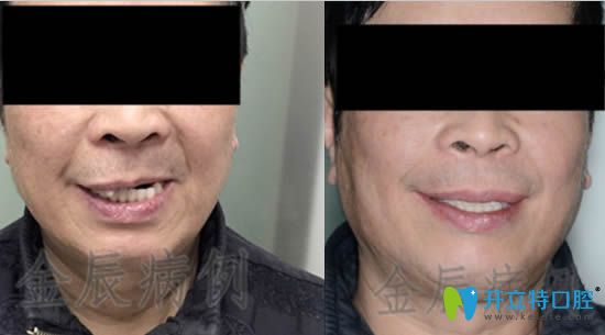 <!--<i data=20240703-sp></i>-->馬瀧齒科金辰allon4種植牙真實 <!--<i data=20240703-sp></i>-->馬瀧齒科金辰allon4種植牙真實