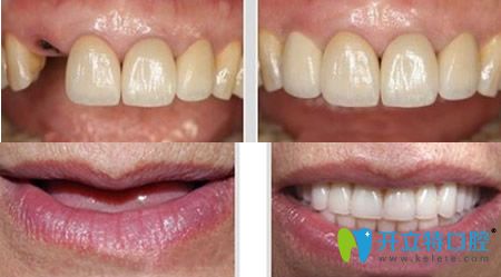 拜博口腔李紹軍院長種植牙案例