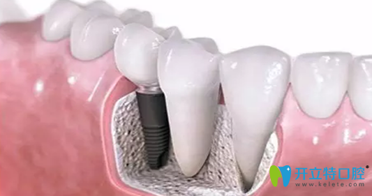 快速植牙技術(shù)