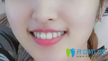 大眾口腔牙齒矯正三年后效果案例