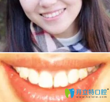 我在西安美奧口腔做隱適美牙齒矯正一年的的效果 我在西安美奧口腔做隱適美牙齒矯正一年的的效果