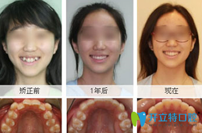 美奧口腔牙齒矯正前后效果對(duì)比圖