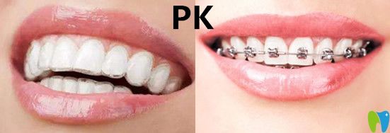 隱形矯正VS傳統(tǒng)牙套哪種效果？有什么區(qū)別呢？