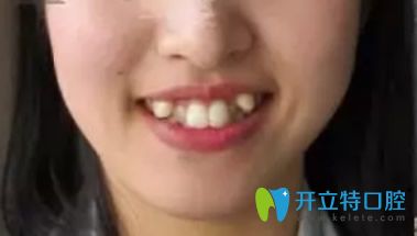 武漢愛尚大眾口腔牙齒矯正前