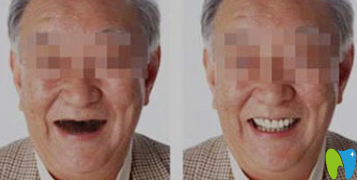 西安美奧口腔屈鐵軍種植牙案例效果圖