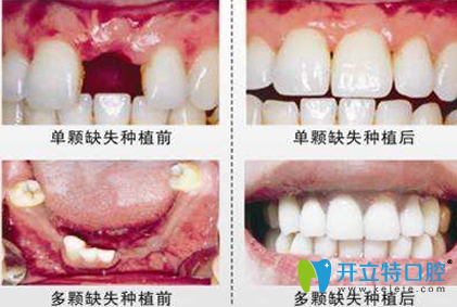 西安美奧口腔種植牙效果對(duì)比圖