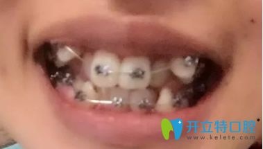 剛帶上金屬牙套