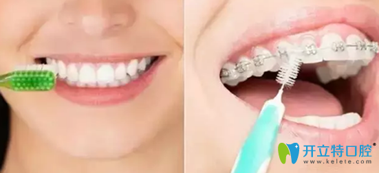 傳統(tǒng)牙套和隱形矯正清潔難易程度對比