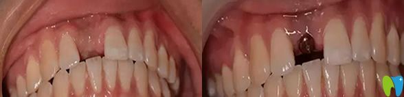 黃院長牙齒缺失案例種植前