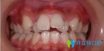 <!--<i data=20240703-sp></i>-->醫(yī)生牙齒矯正案例