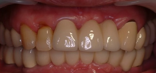 ?65歲王大媽多顆牙缺失在北京永康口腔種植牙齒后心得體會