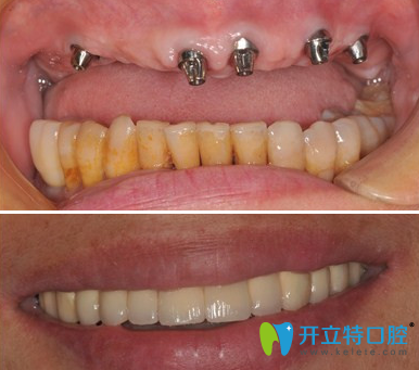 成都瑞泰口腔孫勁東種植牙案例效果圖