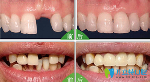 成都瑞泰口腔種植牙效果對(duì)比圖