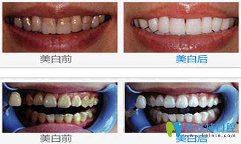 瑞泰口腔牙齒美白效果對(duì)比圖