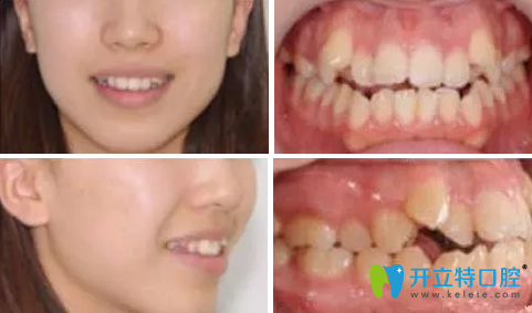 28歲在成都瑞泰口腔做隱形矯正牙，是我這輩子都不后悔的事