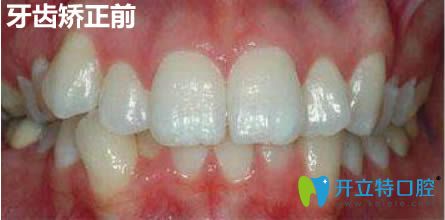 在上海馬瀧齒科做隱適美牙齒矯正12個月啦,來說下我的感受
