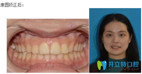 康圓口腔牙齒矯正前后對比圖片