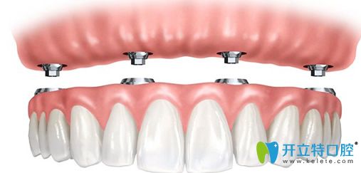 永康口腔黃世宇院長(zhǎng)為王大媽設(shè)計(jì)的診療方案