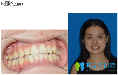 康圓口腔矯正前的照片
