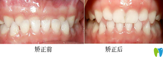 三歲小朋友在杭州拜博口腔做乳牙反頜的矯正案例