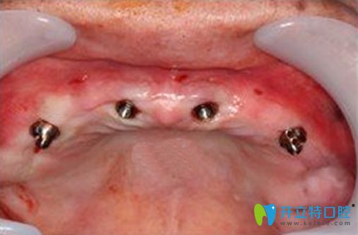 北京永康口腔多顆牙缺失種植效果圖