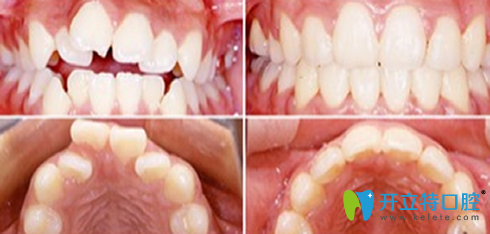 成都瑞泰口腔牙齒矯正前后效果對(duì)比圖