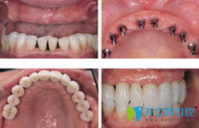 成都瑞泰口腔種植牙前后效果對(duì)比圖