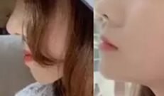 地包天矯正案例:杭州拜博口腔地包天矯正3個月側(cè)臉變化很大