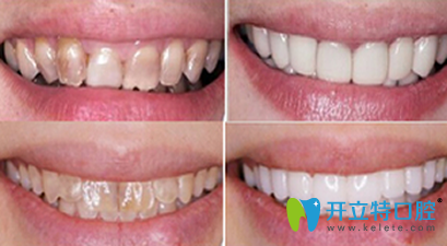 鄭州精益口腔牙齒美白前后效果對比圖
