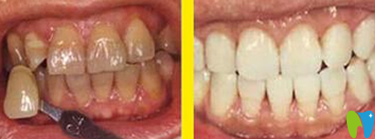 四環(huán)素牙如何變白？看牙齒變白簡單有效的偏方大全