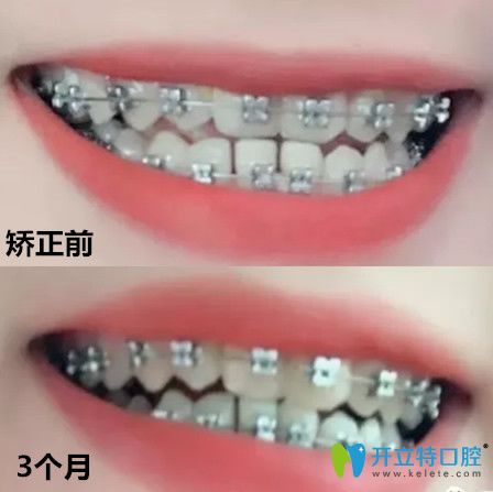 拜博口腔地包天矯正前后牙齒變化對比圖 拜博口腔地包天矯正前后牙齒變化對比圖