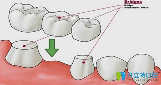 固定義齒能用一輩子嗎?優(yōu)缺點有哪些？南京美奧醫(yī)生解答
