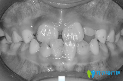 7歲兒子地包天沒有在成都金琴口腔做矯正前樣子