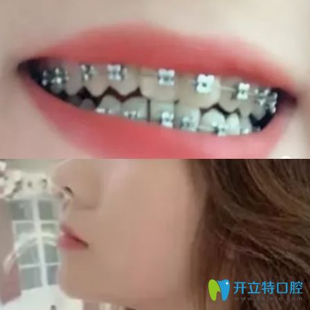 在杭州拜博口腔做地包天矯正3個月牙齒圖片 在杭州拜博口腔做地包天矯正3個月牙齒圖片