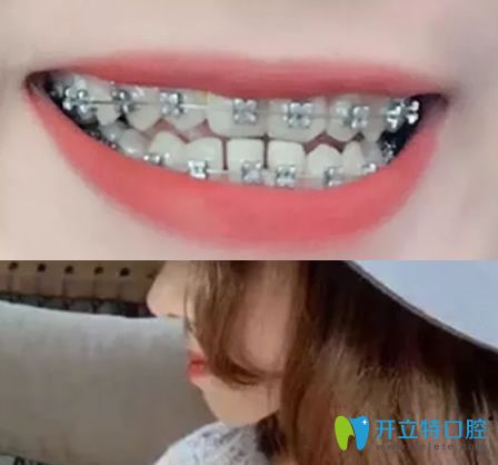 杭州拜博口腔“地包天”矯正戴鋼牙套第1天 杭州拜博口腔“地包天”矯正戴鋼牙套第1天