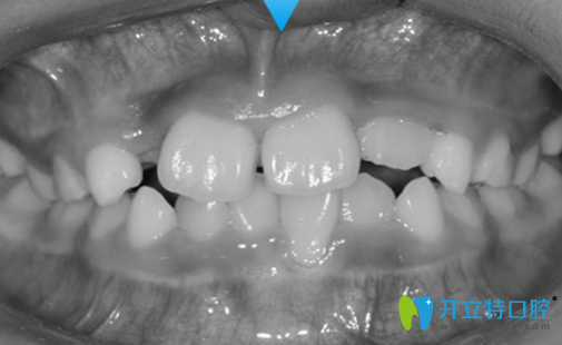 在成都金琴口腔找許楨睿做兒童反頜矯正半年后