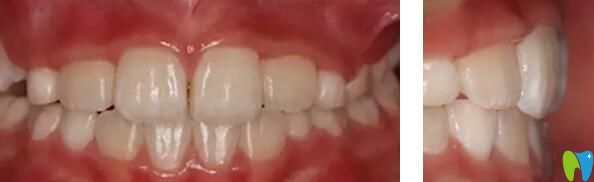 健齒口腔牙齒矯正效果案例 健齒口腔牙齒矯正效果案例